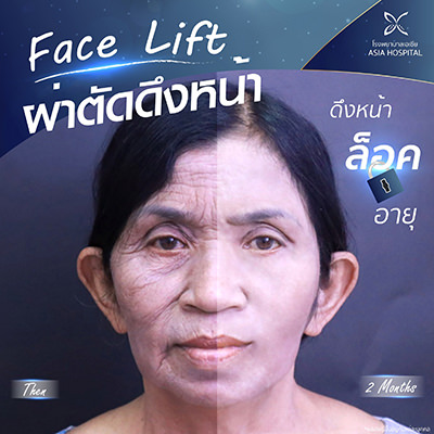 facelift-ดึงหน้า